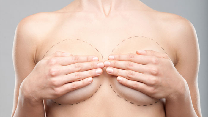 Аугментационная маммопластика / Увеличение груди