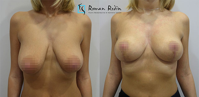 Т-образная подятжка груди без имплантатов