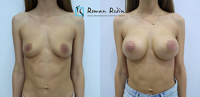 Увеличение груди круглыми имплантатами 350мл