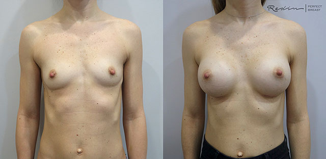 Увеличение груди анатомическими имплантатами 295мл