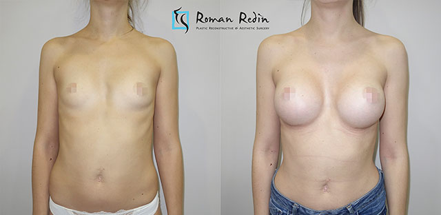 Увеличение груди анатомическими имплантатами 330 и 295мл