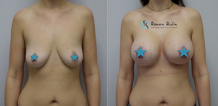 Увеличение груди круглыми имплантами 350мл